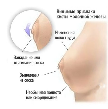 Признаки кисты молочной железы