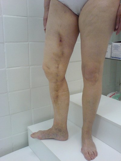 Лечение варикоза ног самара
